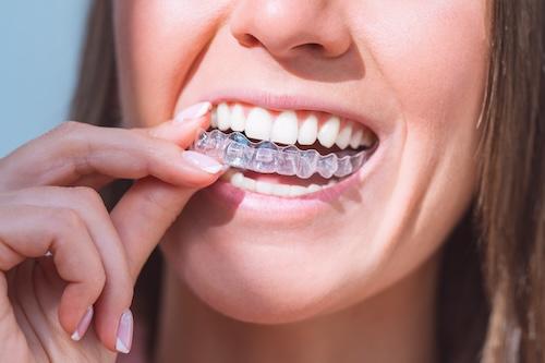 woman using invisalign in duncan