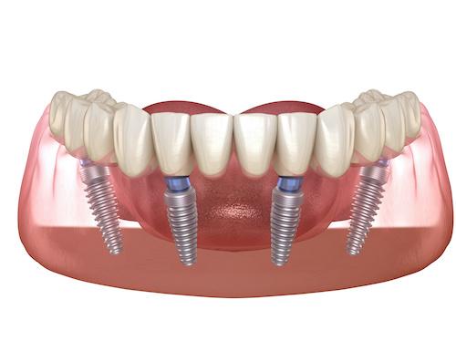 all on 4 dental implants in duncan