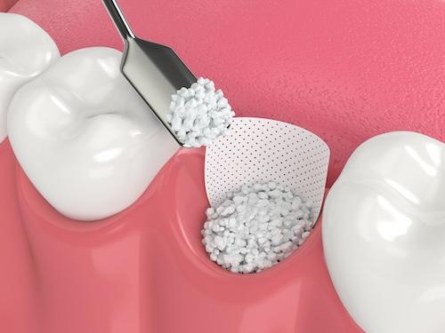 bone grafting procedure 