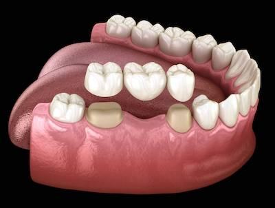 dental bridge to fill tooth gap