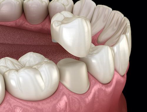 dental crown giong on a tooth 