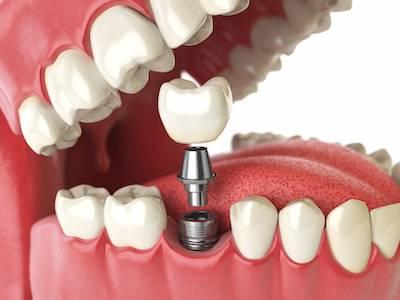 dental implant structure