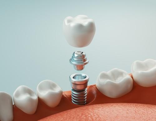 parts of a dental implant