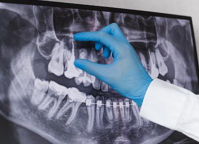 dentist showing root of tooth on xray