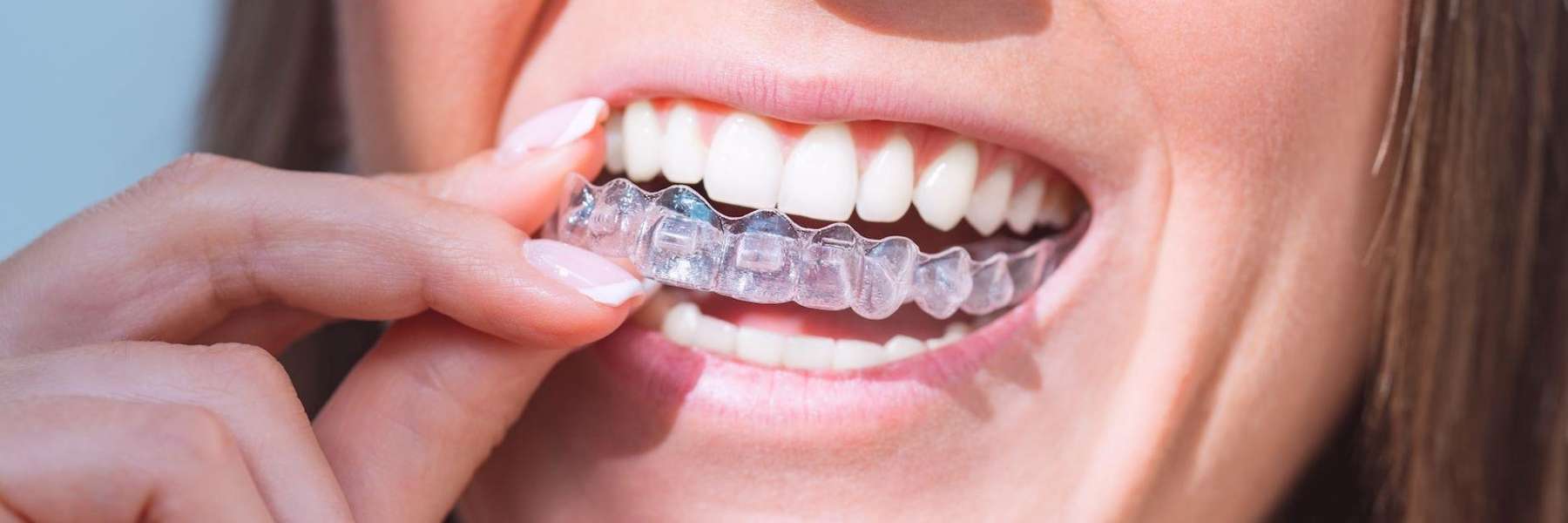 A smiling woman shows her clear braces, emphasizing the confidence and smile improvement Invisalign®