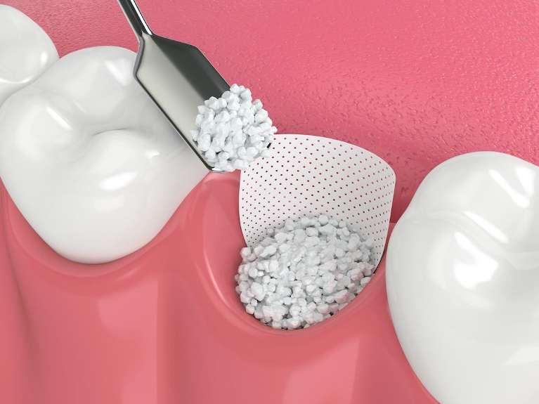 an illustration of bone grafting procedure