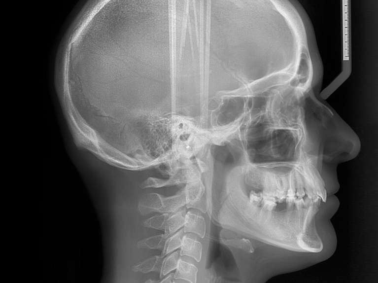 Cephalometric (Ceph) X-Ray